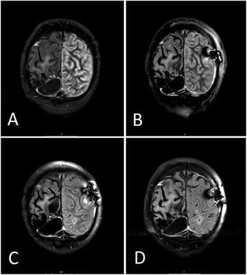 Case Report: SMART ANTON: Anton-Babinski Syndrome in Stroke-Like Migraine Attacks (SMART) After Radiation Therapy: Two Rare Syndromes, One Case